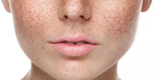 Best Treatment for Pigmentation