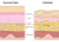 Unveiling Cellulite: Myths, Facts, and Empowered Understanding