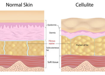 Unveiling Cellulite: Myths, Facts, and Empowered Understanding