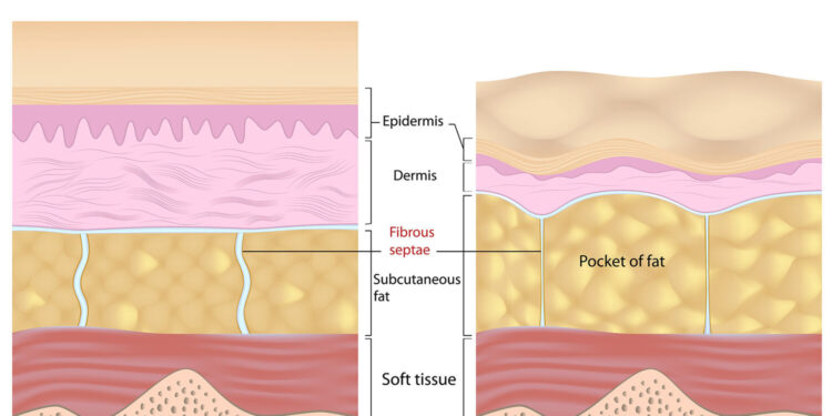 Unveiling Cellulite: Myths, Facts, and Empowered Understanding